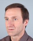 After Hair Transplant&nbsp;Front